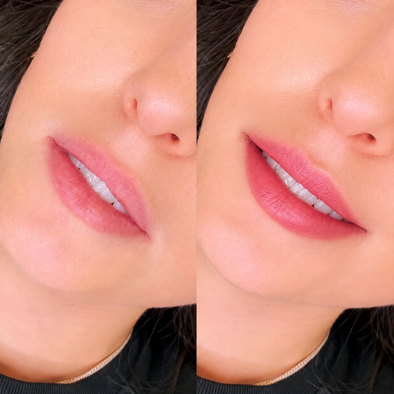 Lip flip before and after results